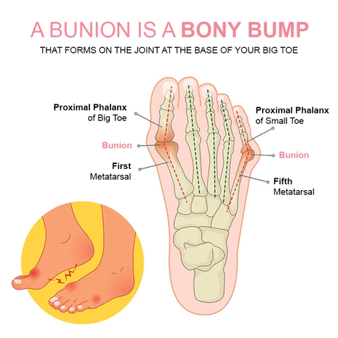 Patch Anti Bunion StrongJoints