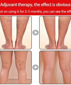 Alternative view of Varicose Veins Edema Care Socks