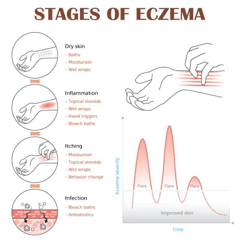 ATTDX EczemaRelief Treatment Spray - Image 8