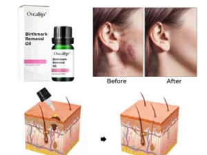 CC™ Birthmark Removal Oil
