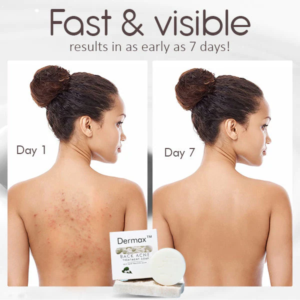Dermax™ Back Acne Treatment Soap - Image 5