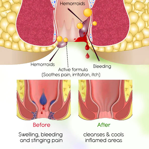 EzRelief™ Hemorrhoid ಸಿಟ್ಜ್ ಬಾತ್ ಪ್ಯಾಕ್