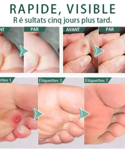 FootPro™ Gel extra-fort pour l'élimination du maïs