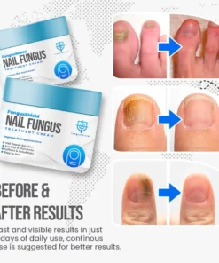Fungus Shield Nail Treatment Cream