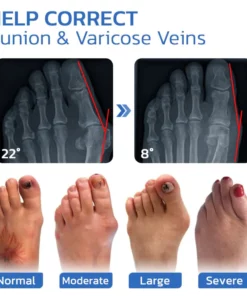 GFOUK™ AntiBunion and VeinHeal Health Socks