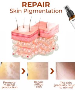 IMAGS™ Vitiligo Relief Spray