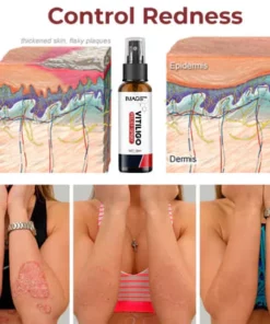 IMAGS™ Vitiligo Relief Spray