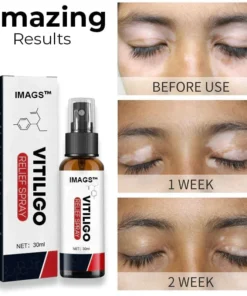 IMAGS™ Vitiligo Relief Spray
