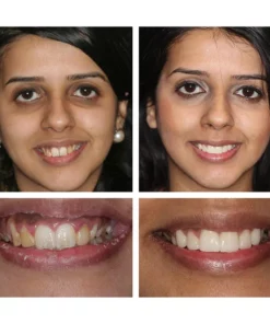 Lanthome™ Esencia blanqueadora de dientes