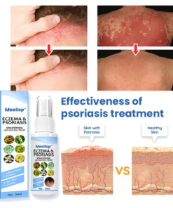 Meellop™ Herbal Psoriasis Relief Spray