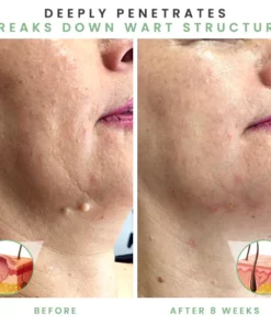 MicroDarts Spot Removal Patch