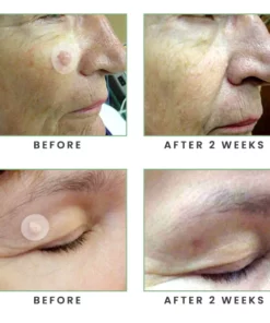 MicroDarts Spot Removal Patch