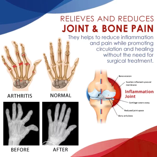 TherapyX™ ג'ל לטיפול במפרקים ובעצמות