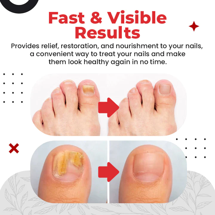 Toenail Pro™ Anti-Fungus Relief Oil - Image 3