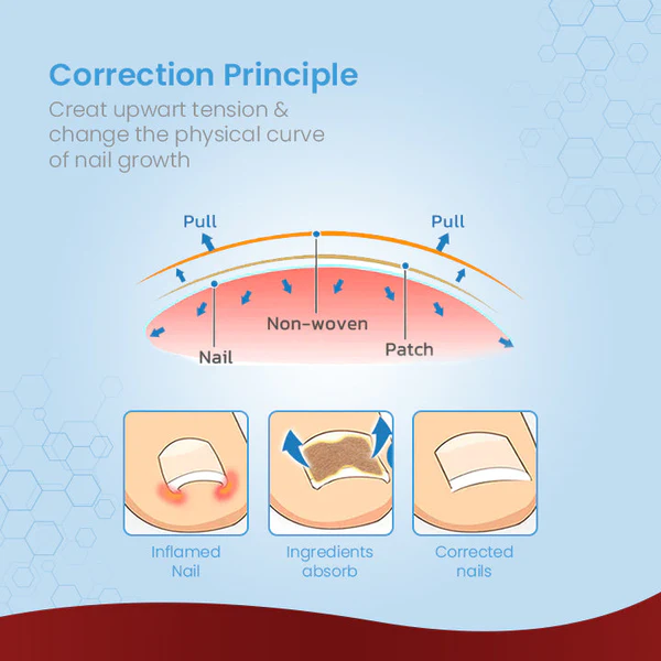 ToenailPro ™ ጀርመንኛ Paronychia Relief Patch