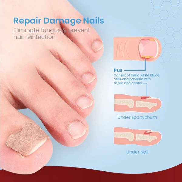 ToenailPro™ Patch di Rilievu di Paronychia Tedesca