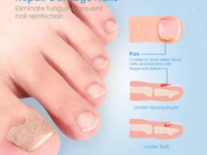 ToenailPro™ German Paronychia Relief Patch