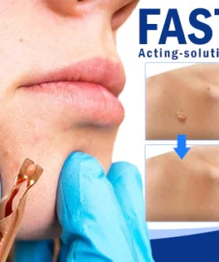 Alternative view of Wart Removal Sterile Clip