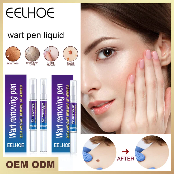 Wart na-ewepụ mkpịsị akwụkwọ