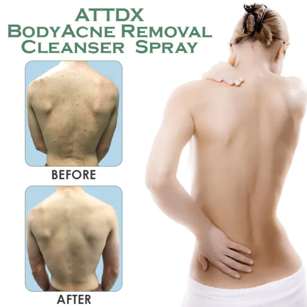 ATTDX Спреј за чистење на телото за отстранување акни