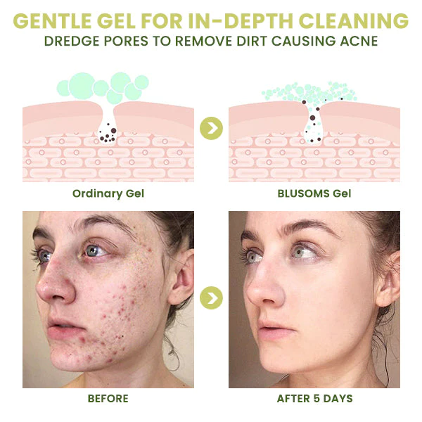 Blusoms™ ClearAcne Defense Gel - Image 3
