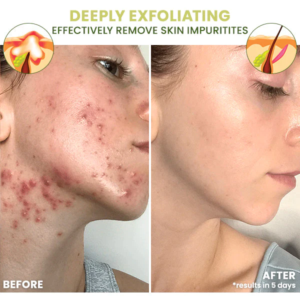 Blusoms™ ClearAcne Defense Gel - Image 5