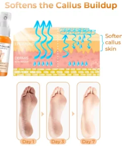 Croaie™ Anti Foot Callus Removal Spray
