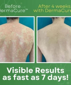 DermaCure™ Psoriasis Cream