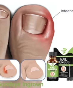 FOOTCARE™ Entfernungs-Gel für Paronychien