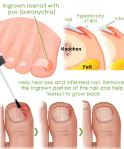 FOOTCARE™ Removal Paronychia Gel