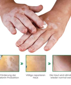 Fivfivgo™ VitiligoFix Revitalisierendes Elixier