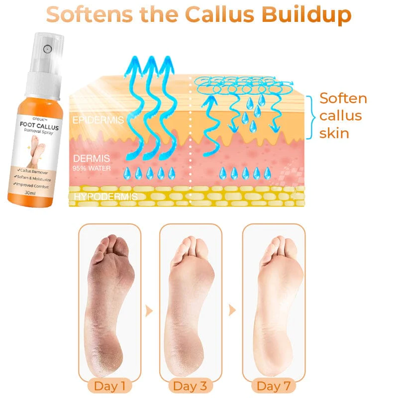 GFOUK™ Foot Callus Removal Spray - Buy Today Get 55% Discount