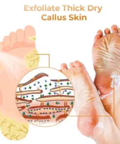 GFOUK™ Anti Foot Callus Removal Spray