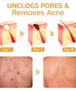 GFOUK™ FAFASKIN Rückenflecken und Akanthose Nigricans Reinigungslotion