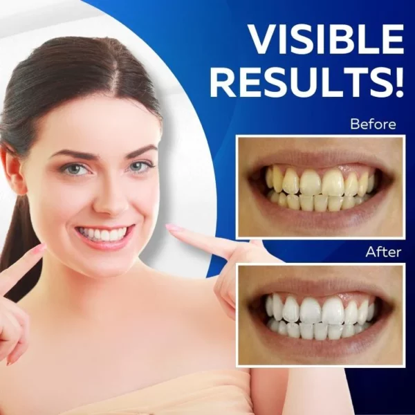 Полоски для отбеливания зубов Gleam3D™