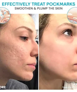 Liascy™ Baume HyaloVitality Microdarts Roller