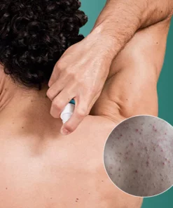 PureBAC™ Back Acne Herbal Spray