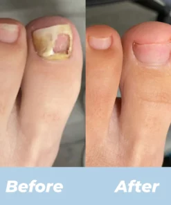 ARRIVALS Antifungal Laser Device Without Any Side Effects