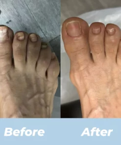 ARRIVALS Antifungal Laser Device Without Any Side Effects