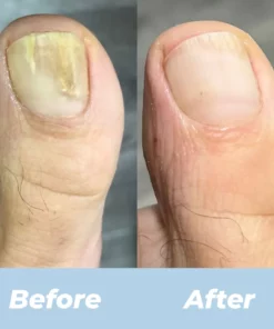 ARRIVALS Antifungal Laser Device Without Any Side Effects