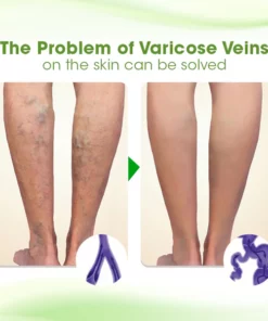 Biancat™ VariMend Varicose Vein Cream