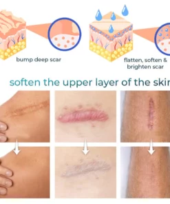 CNDB Bioskin™ Advanced Scar Removal Gel