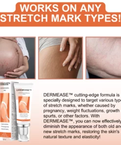 DERMEASE™ Stretchmarks Removal Cream