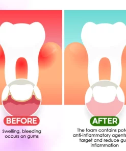 DentiCare™ Gum Treatment Foam