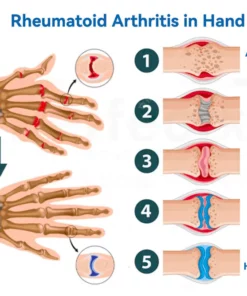 Fivfivgo™ Gelenk- und Knochentherapie-Gel - Ganzkörper-Wiederherstellung