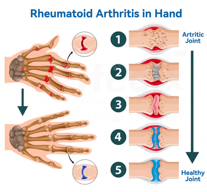 Fivfivgo™ Gelenk- und Knochentherapie-Gel - Ganzkörper-Wiederherstellung