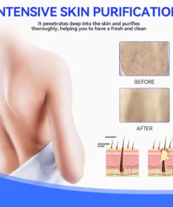 Fivfivgo™ Keratosis Pilaris & Akne Behandlung Körper Erfrischende Creme