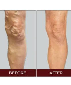 Fivfivgo™ Varicose Veins Relief Cream