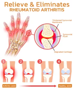 GFOUK™ Bee Venom Joint and Bone Therapy Spray