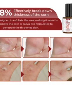 GFOUK™ Foot Corn Removal Extra Strengthen Gel